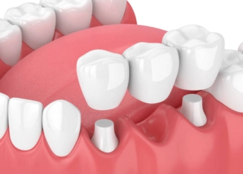 Dental Bridges