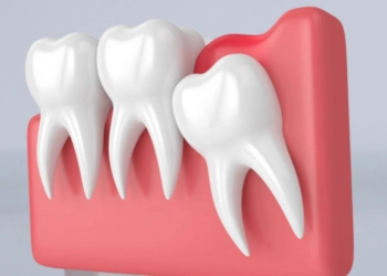 Wisdom Tooth